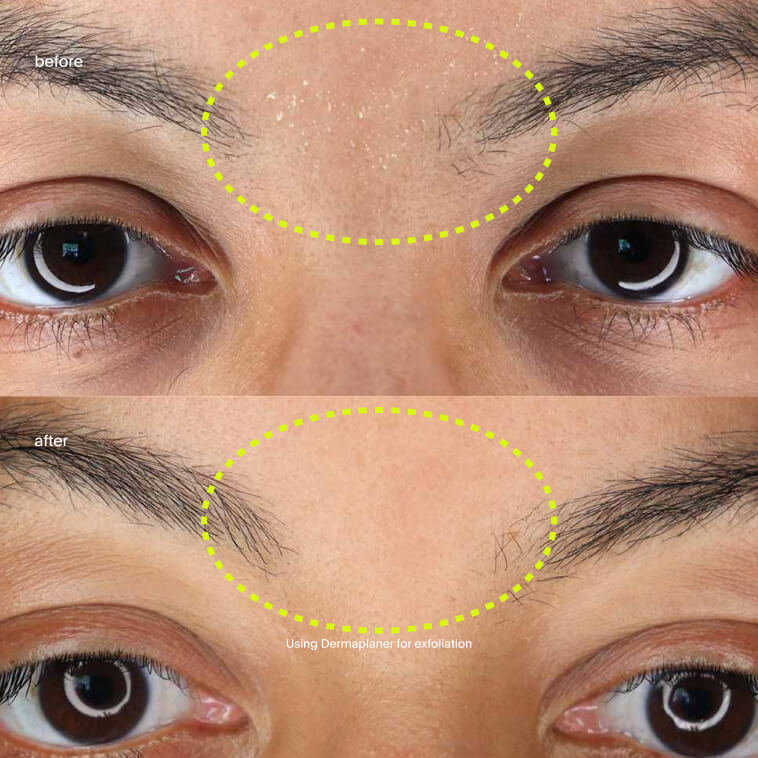 Before and after of the area between the eyebrows with the dermaplaner