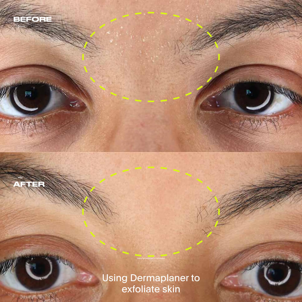 A before and after of the area between the eyebrows using the dermaplaner